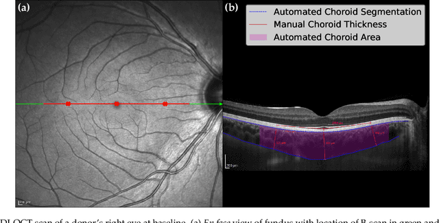 Figure 2 for Evaluation of an automated choroid segmentation algorithm in a longitudinal kidney donor and recipient cohort