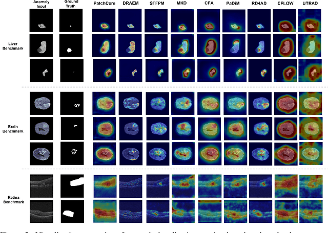 Figure 4 for BMAD: Benchmarks for Medical Anomaly Detection