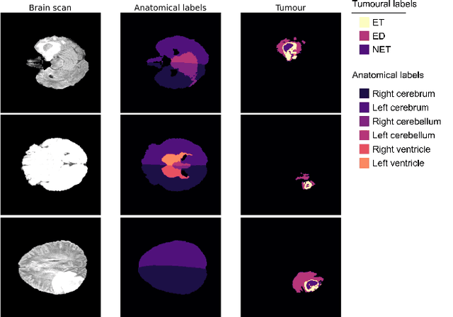 Figure 3 for MOC-AE: An Anatomically-Pathological-Based model for Clinical Decision Support System of tumoural brain images