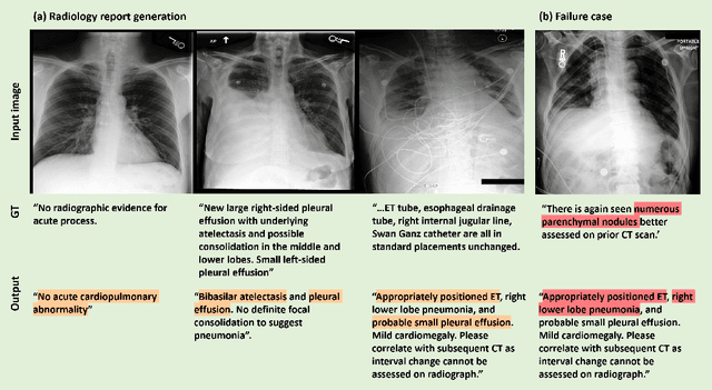 Figure 3 for LLM Itself Can Read and Generate CXR Images