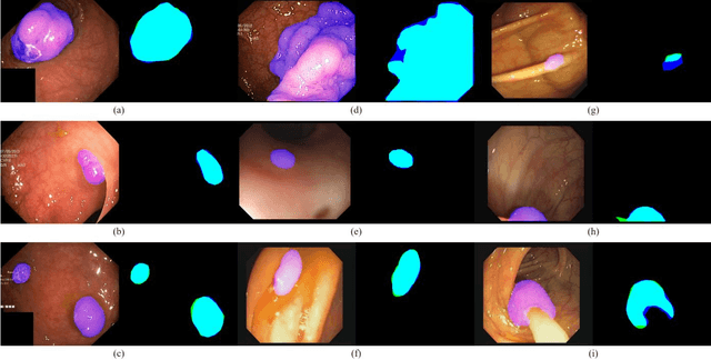 Figure 2 for Rethinking the transfer learning for FCN based polyp segmentation in colonoscopy