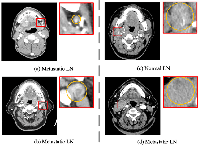 Figure 3 for Integrating features from lymph node stations for metastatic lymph node detection