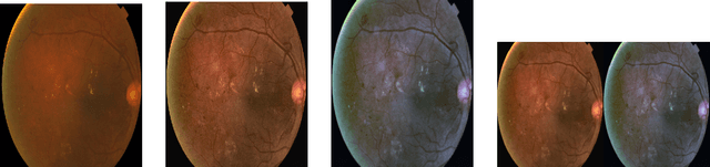 Figure 1 for Detecting diabetic retinopathy severity through fundus images using an ensemble of classifiers