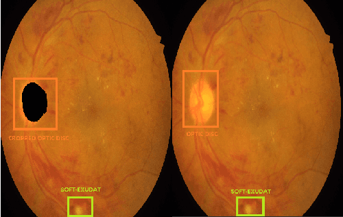 Figure 4 for Detecting diabetic retinopathy severity through fundus images using an ensemble of classifiers