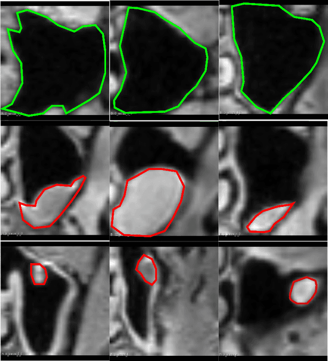 Figure 4 for Multiple Instance Ensembling For Paranasal Anomaly Classification In The Maxillary Sinus