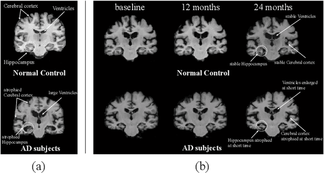 Figure 1 for Longformer: Longitudinal Transformer for Alzheimer's Disease Classification with Structural MRIs