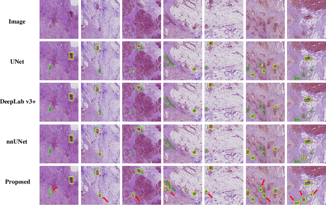Figure 2 for A Weakly Supervised Segmentation Network Embedding Cross-scale Attention Guidance and Noise-sensitive Constraint for Detecting Tertiary Lymphoid Structures of Pancreatic Tumors