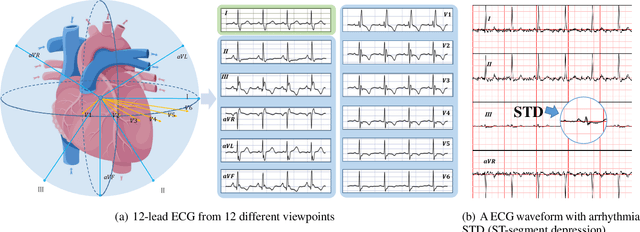 Figure 1 for MVKT-ECG: Efficient Single-lead ECG Classification on Multi-Label Arrhythmia by Multi-View Knowledge Transferring
