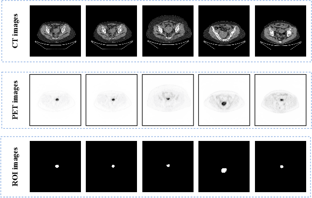 Figure 2 for ECPC-IDS:A benchmark endometrail cancer PET/CT image dataset for evaluation of semantic segmentation and detection of hypermetabolic regions