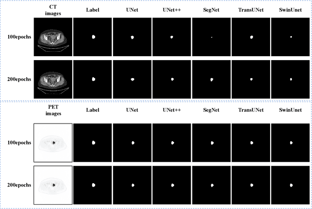 Figure 4 for ECPC-IDS:A benchmark endometrail cancer PET/CT image dataset for evaluation of semantic segmentation and detection of hypermetabolic regions