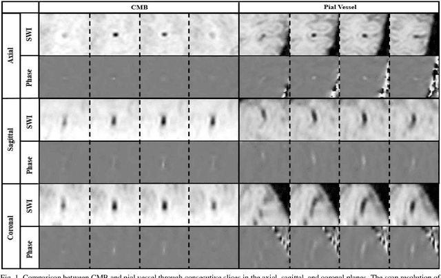 Figure 1 for Toward Automated Detection of Microbleeds with Anatomical Scale Localization: A Complete Clinical Diagnosis Support Using Deep Learning