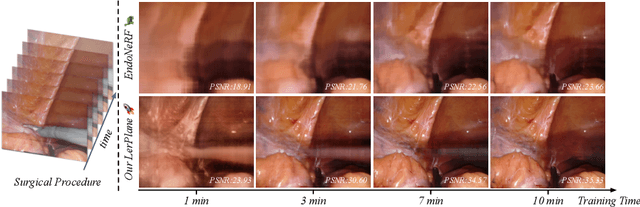 Figure 1 for Neural LerPlane Representations for Fast 4D Reconstruction of Deformable Tissues
