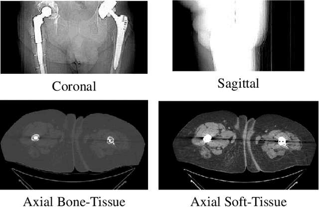 Figure 1 for Early detection of hip periprosthetic joint infections through CNN on Computed Tomography images