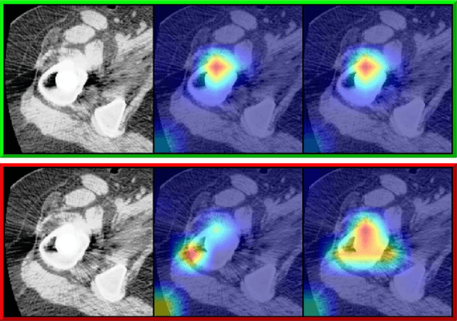 Figure 4 for Early detection of hip periprosthetic joint infections through CNN on Computed Tomography images