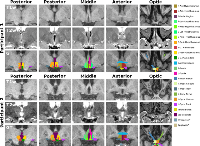 Figure 1 for FastSurfer-HypVINN: Automated sub-segmentation of the hypothalamus and adjacent structures on high-resolutional brain MRI