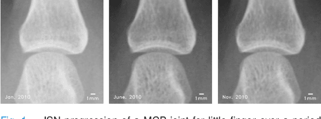 Figure 1 for A Deep Registration Method for Accurate Quantification of Joint Space Narrowing Progression in Rheumatoid Arthritis