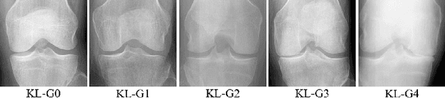 Figure 1 for Automatic diagnosis of knee osteoarthritis severity using Swin transformer