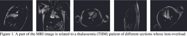 Figure 1 for CHMMOTv1 -- Cardiac and Hepatic Multi-Echo (T2*) MRI Images and Clinical Dataset for Iron Overload on Thalassemia Patients