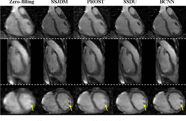 Figure 4 for Score-based Diffusion Models With Self-supervised Learning For Accelerated 3D Multi-contrast Cardiac Magnetic Resonance Imaging