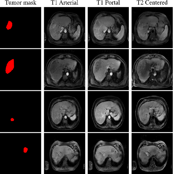Figure 4 for Mask-guided Data Augmentation for Multiparametric MRI Generation with a Rare Hepatocellular Carcinoma