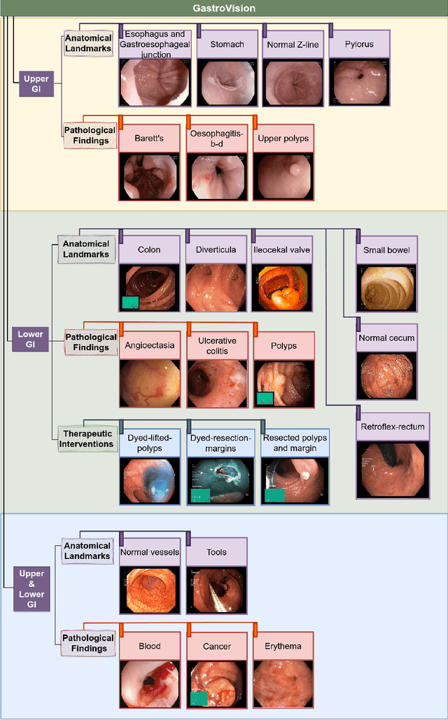 Figure 2 for GastroVision: A Multi-class Endoscopy Image Dataset for Computer Aided Gastrointestinal Disease Detection