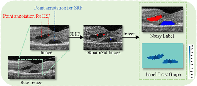 Figure 1 for Learning from Noisy Labels Generated by Extremely Point Annotations for OCT Fluid Segmentation