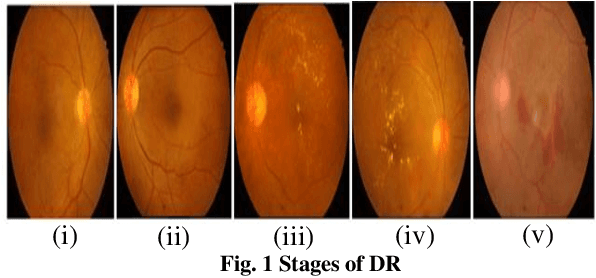 Figure 2 for Leveraging Semi-Supervised Graph Learning for Enhanced Diabetic Retinopathy Detection