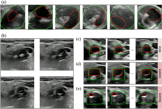 Figure 1 for Inflated 3D Convolution-Transformer for Weakly-supervised Carotid Stenosis Grading with Ultrasound Videos