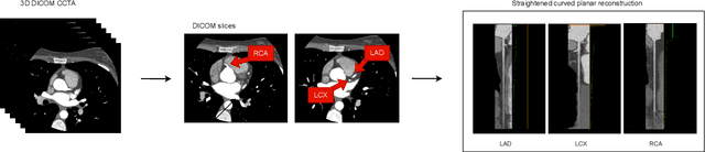 Figure 1 for CAD-RADS scoring of coronary CT angiography with Multi-Axis Vision Transformer: a clinically-inspired deep learning pipeline