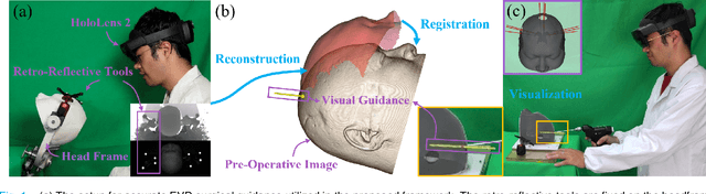 Figure 1 for EVD Surgical Guidance with Retro-Reflective Tool Tracking and Spatial Reconstruction using Head-Mounted Augmented Reality Device