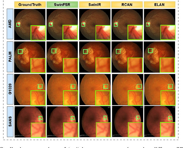 Figure 4 for Revolutionizing Space Health (Swin-FSR): Advancing Super-Resolution of Fundus Images for SANS Visual Assessment Technology