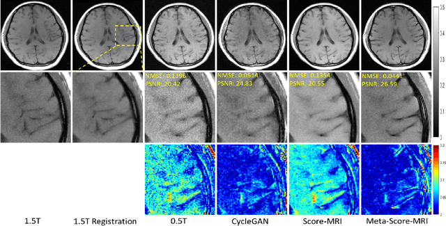 Figure 4 for Meta-Learning Enabled Score-Based Generative Model for 1.5T-Like Image Reconstruction from 0.5T MRI