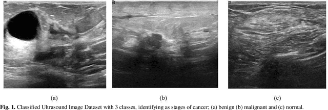 Figure 1 for CEIMVEN: An Approach of Cutting Edge Implementation of Modified Versions of EfficientNet (V1-V2) Architecture for Breast Cancer Detection and Classification from Ultrasound Images