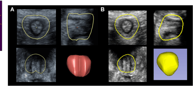 Figure 3 for DEEPBEAS3D: Deep Learning and B-Spline Explicit Active Surfaces