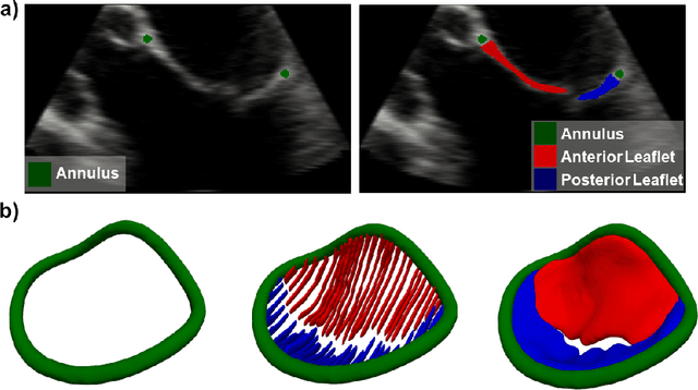 Figure 1 for A Deep Learning-Based and Fully Automated Pipeline for Regurgitant Mitral Valve Anatomy Analysis from 3D Echocardiography
