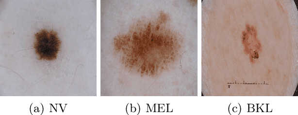 Figure 3 for Fine-tuning of explainable CNNs for skin lesion classification based on dermatologists' feedback towards increasing trust