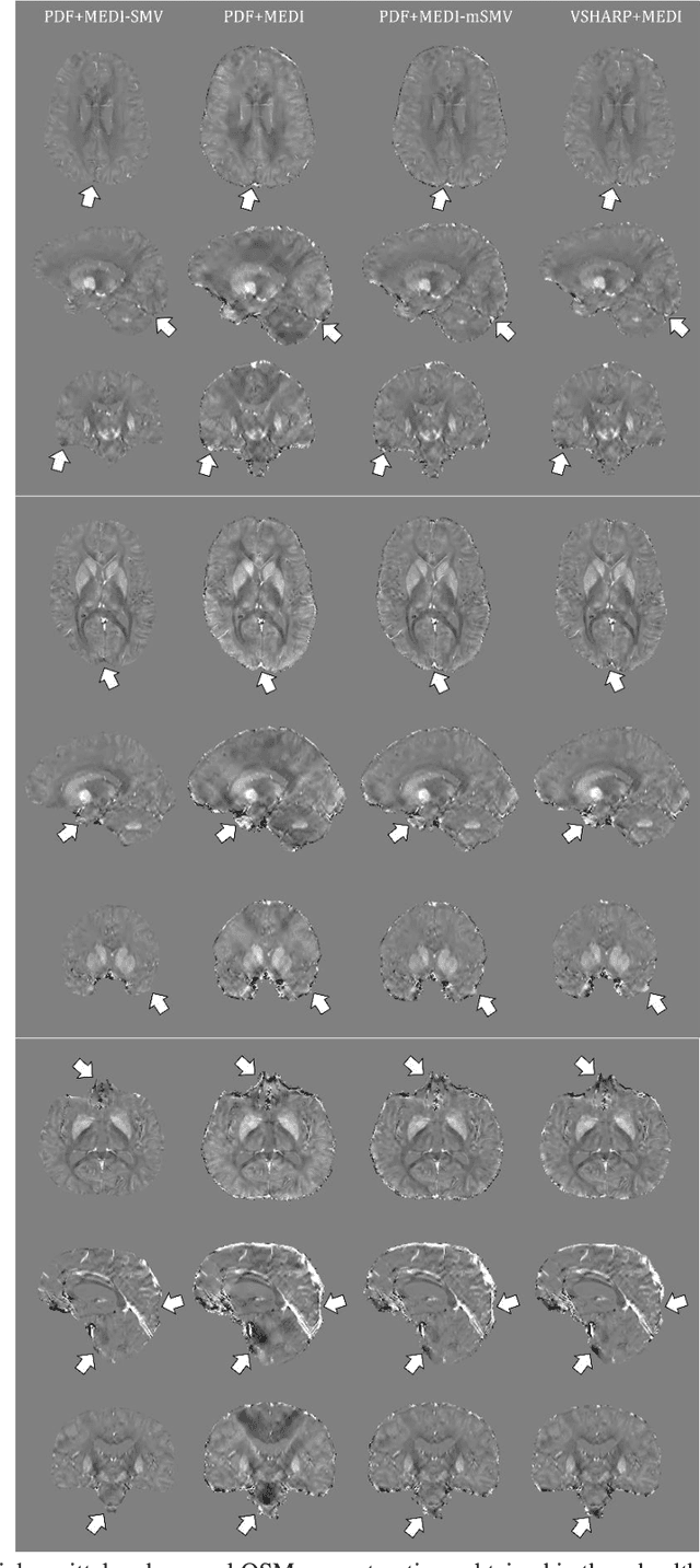 Figure 2 for Maximum Spherical Mean Value (mSMV) Filtering for Whole Brain Quantitative Susceptibility Mapping