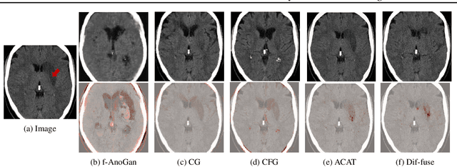 Figure 3 for Diffusion Models for Counterfactual Generation and Anomaly Detection in Brain Images
