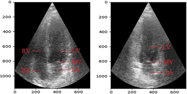 Figure 1 for Estimation of mitral valve hinge point coordinates -- deep neural net for echocardiogram segmentation