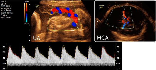 Figure 1 for An Automatic Guidance and Quality Assessment System for Doppler Imaging of Umbilical Artery