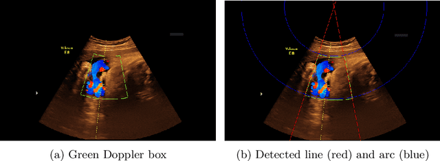 Figure 4 for An Automatic Guidance and Quality Assessment System for Doppler Imaging of Umbilical Artery