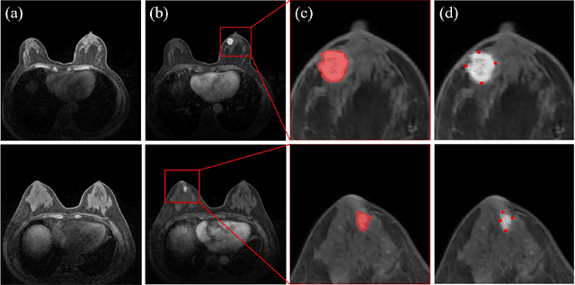 Figure 1 for SimPLe: Similarity-Aware Propagation Learning for Weakly-Supervised Breast Cancer Segmentation in DCE-MRI