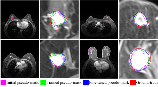 Figure 4 for SimPLe: Similarity-Aware Propagation Learning for Weakly-Supervised Breast Cancer Segmentation in DCE-MRI