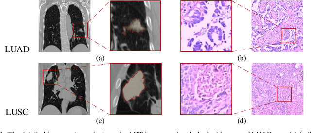 Figure 1 for Classification of lung cancer subtypes on CT images with synthetic pathological priors