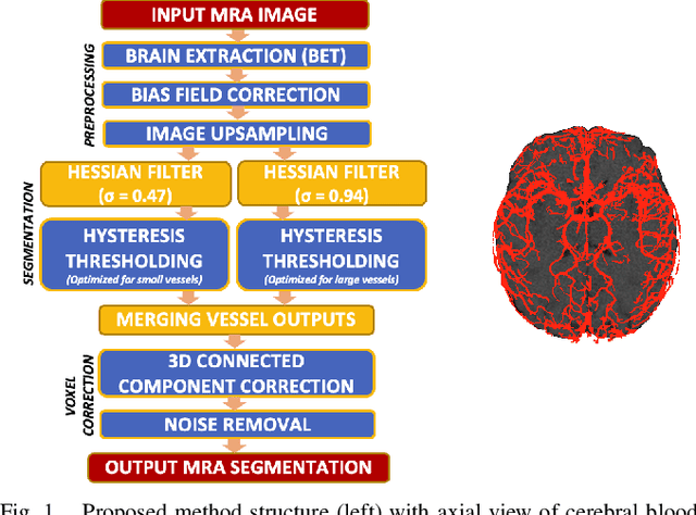 Figure 1 for Segmentation method for cerebral blood vessels from MRA using hysteresis