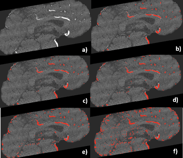 Figure 2 for Segmentation method for cerebral blood vessels from MRA using hysteresis