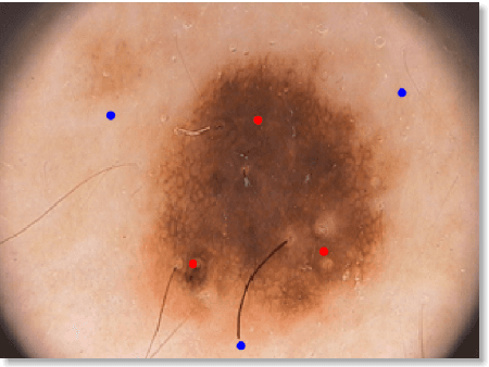 Figure 3 for Beyond Visual Image: Automated Diagnosis of Pigmented Skin Lesions Combining Clinical Image Features with Patient Data