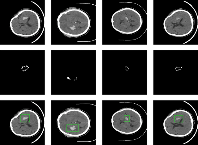 Figure 2 for PHE-SICH-CT-IDS: A Benchmark CT Image Dataset for Evaluation Semantic Segmentation, Object Detection and Radiomic Feature Extraction of Perihematomal Edema in Spontaneous Intracerebral Hemorrhage