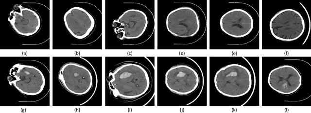 Figure 3 for PHE-SICH-CT-IDS: A Benchmark CT Image Dataset for Evaluation Semantic Segmentation, Object Detection and Radiomic Feature Extraction of Perihematomal Edema in Spontaneous Intracerebral Hemorrhage