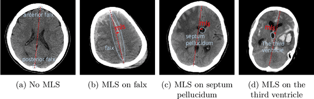 Figure 1 for Diffusion Model based Semi-supervised Learning on Brain Hemorrhage Images for Efficient Midline Shift Quantification
